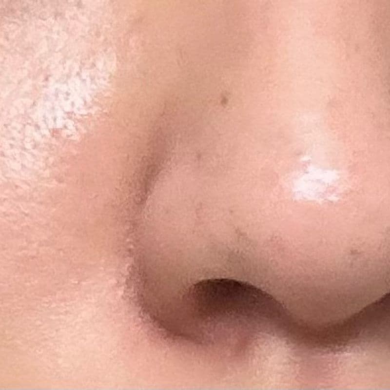 20대부터 하는 피부관리 꿀팁! 보톡스, 아쿠아필, 리프팅 등 내돈내산 후기